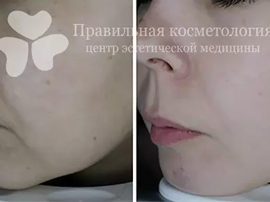 Интралипотерапия или как убрать второй подбородок