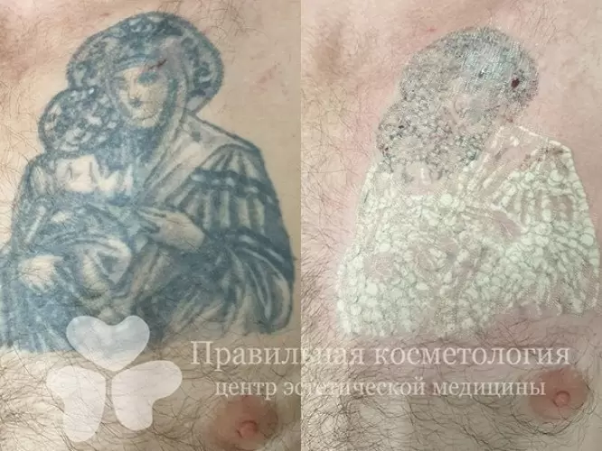 Убрать некрасивый татуаж